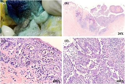 Mammary Paget Disease With Melanocytic Proliferation Mimicking Malignant Melanoma in situ: A Case Report